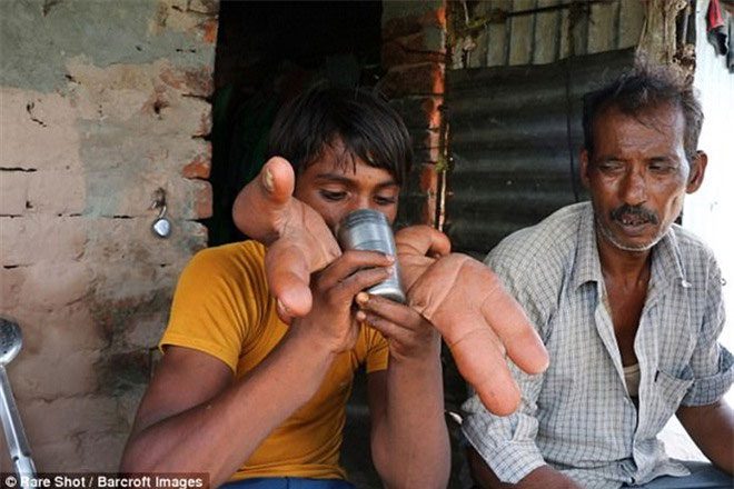 He lives like a disabled person, always needing help from others.