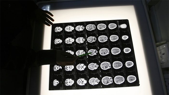 Man loses sense of fear after brain surgery.