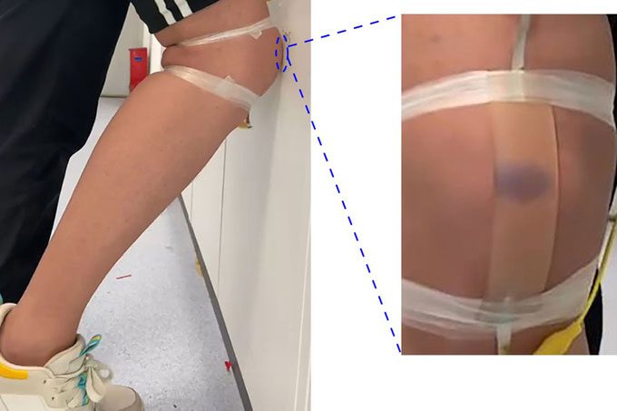 Experiment causing I-skin artificial skin to bruise