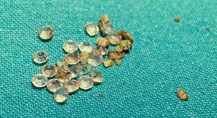 Diamonds removed from Frosty's stomach.