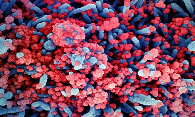 Severely infected nCoV cells under a scanning electron microscope.