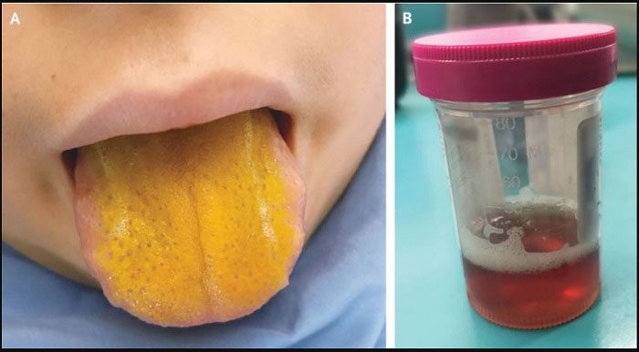 The rare disease causing the boy to have a yellow tongue, dark urine, sore throat, and continuous abdominal pain.