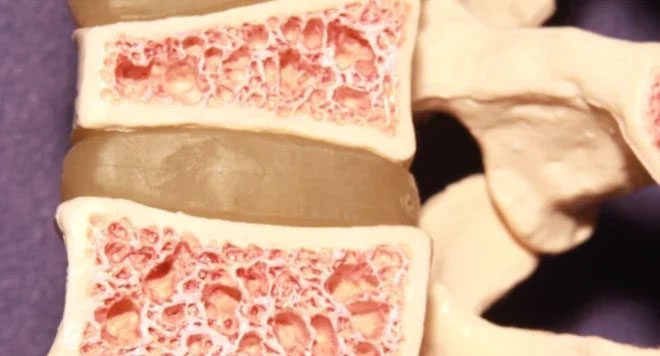 Sclerosteosis