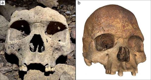 Skull with the jawbone surgically removed