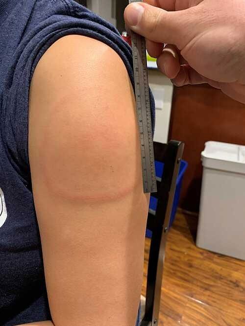 A 15cm rash on the arm of a Moderna vaccine recipient.