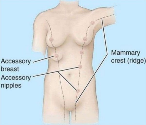 Diagram showing the "milk line" and the presence of accessory breast tissue along this line.