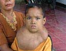 13 years living with massive tumor 2166