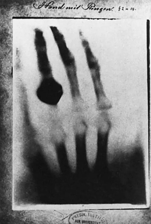 The first X-ray photograph taken by Wilhelm Conrad Roentgen.