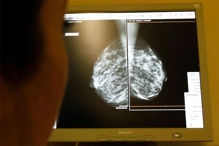 A doctor examining a mammogram