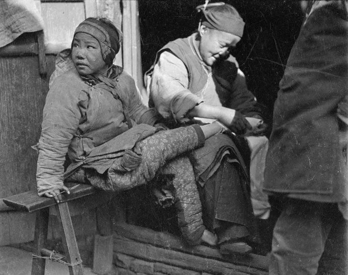 Women helping each other with foot binding, photographed in Zhejiang, around 1917-1919.