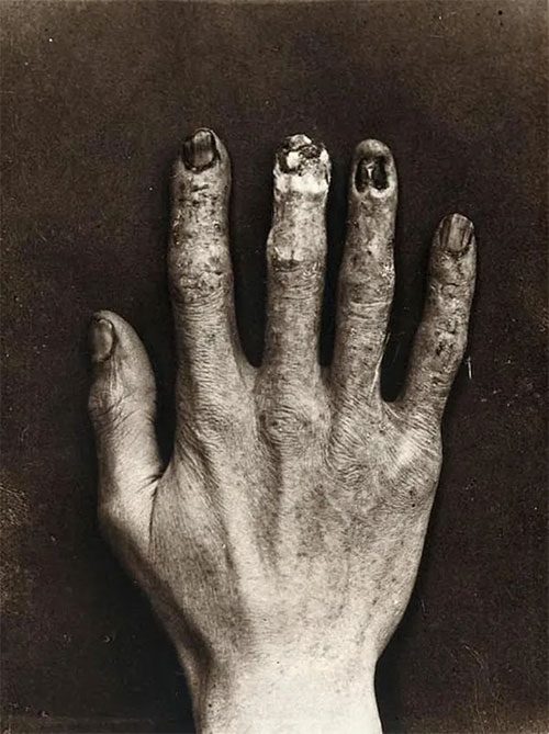 Dally's left hand after multiple exposures to radiation, always covered in burns.