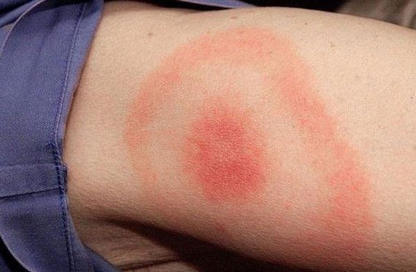 Signs of Lyme disease include a small, red swelling, similar to a mosquito bite.