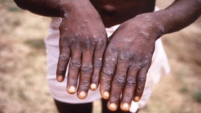 Monkeypox patient in the Democratic Republic of the Congo.