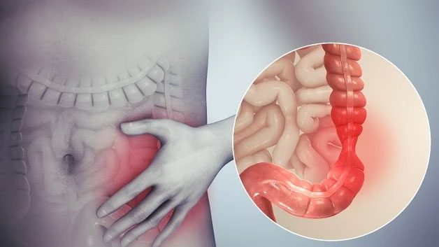 Dietary habits and stress can elevate the risk of intestinal inflammation.