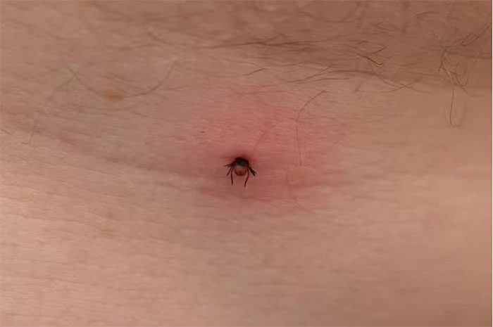 Many people do not realize they have been bitten by a tick