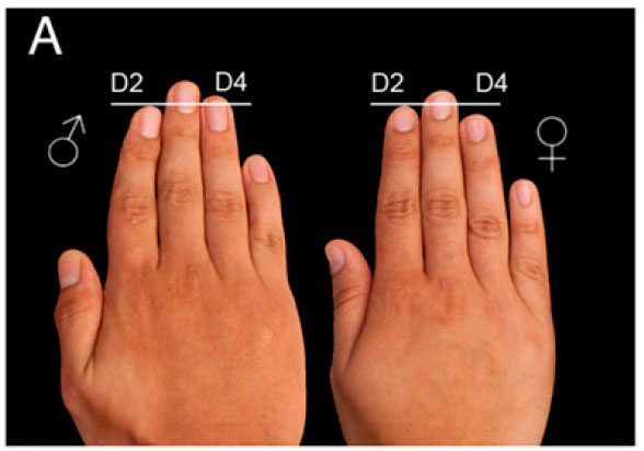 A long ring finger indicates high testosterone and low estrogen levels.