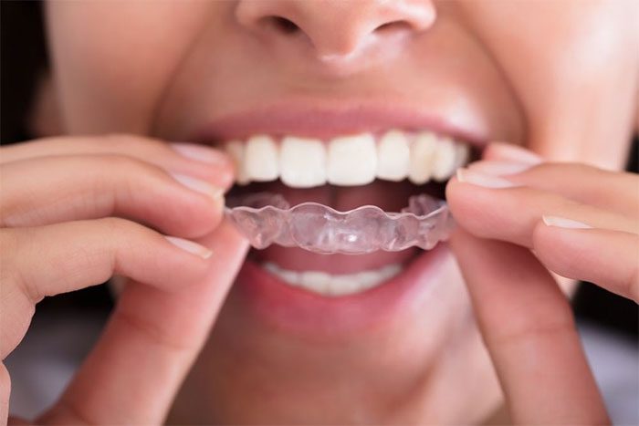 A mouth guard is a useful tool to reduce teeth grinding during sleep.