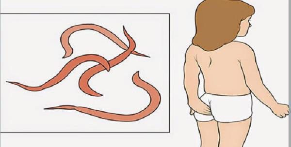 Pinworms often gather at children's anus, causing uncomfortable itching.