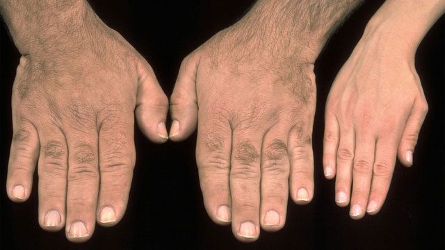 Acromegaly is a complex but treatable condition.