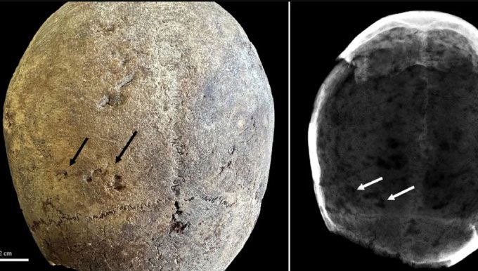 Skull of one of the 17th-century individuals testing positive for cocaine