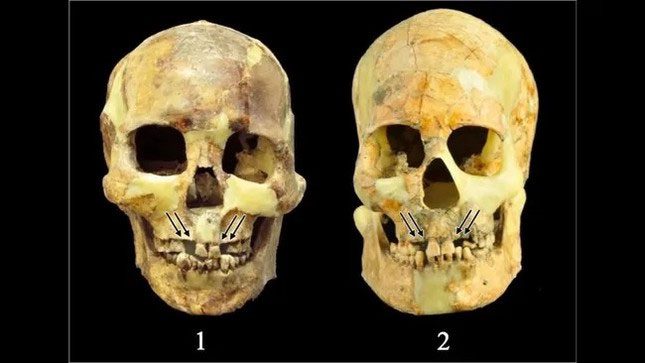 Example of tooth extraction on two skeletons. The arrows point to the extracted teeth.