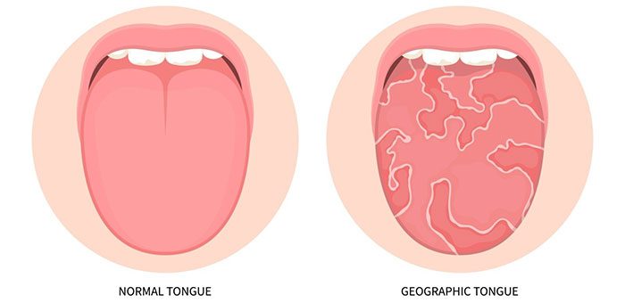 Geographic tongue is a condition where the tongue surface shows alternating patches of red and white