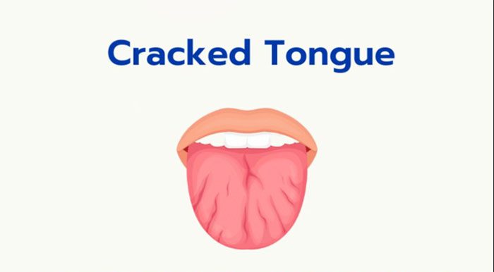 Fissured tongue is a condition where deep grooves appear on the tongue's surface