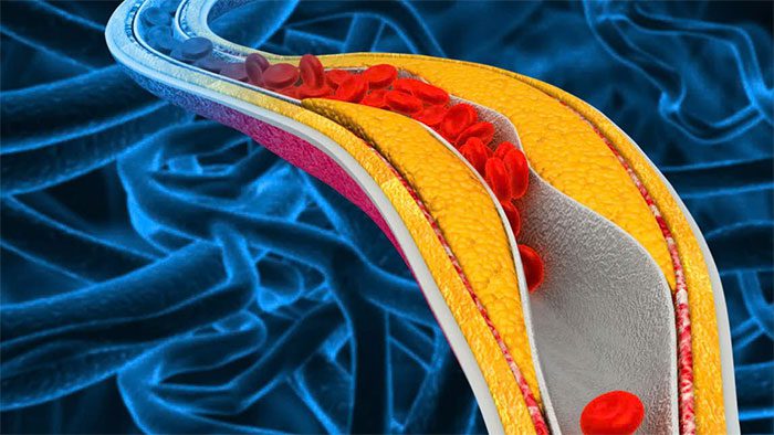 Heavy metals in drinking water or air can cause calcium buildup in the arteries