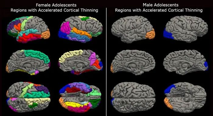 Image showing cortical thinning in female adolescents compared to male adolescents.