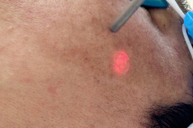 Melasma patches on a man's skin.