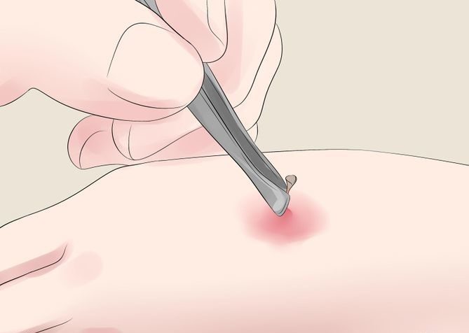 Using Tweezers to Remove the Stinger