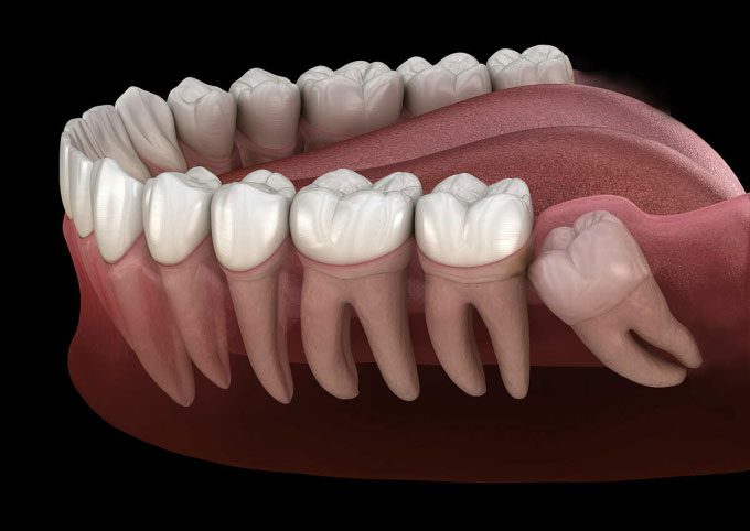 Illustration of a wisdom tooth growing misaligned, impacting the adjacent molar.