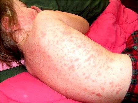 Children with dengue fever develop rashes on the arms, legs, and torso.