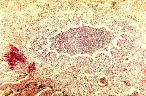 Bronchiolitis in infants with pneumonia due to whooping cough.