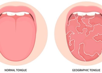 the strange features of the human tongue phenomenon of the touch tongue the map tongue and the scalloped tongue 137473