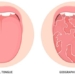 the strange features of the human tongue phenomenon of the touch tongue the map tongue and the scalloped tongue 137473