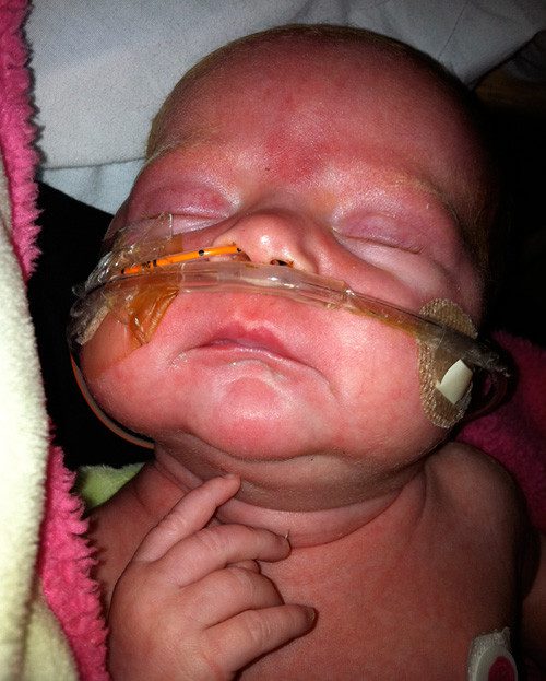 An infant being treated for severe whooping cough.