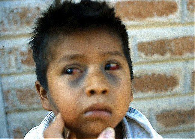 A child with burst blood vessels in the eyes and bruising on the face due to excessive coughing from whooping cough.