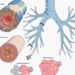 vn the highest rate of people with chronic obstructive pulmonary disease in the asia pacific region 1310