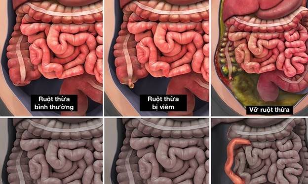 Appendiceal rupture causes pus leakage and bacteria to enter the abdominal cavity.