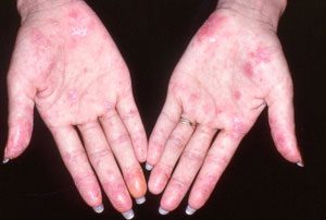 Lupus