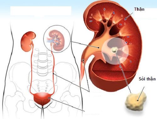 All you need to know about kidney stones