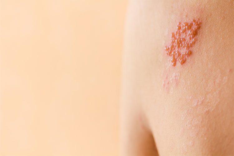 Most cases of shingles resolve within 2-3 weeks.