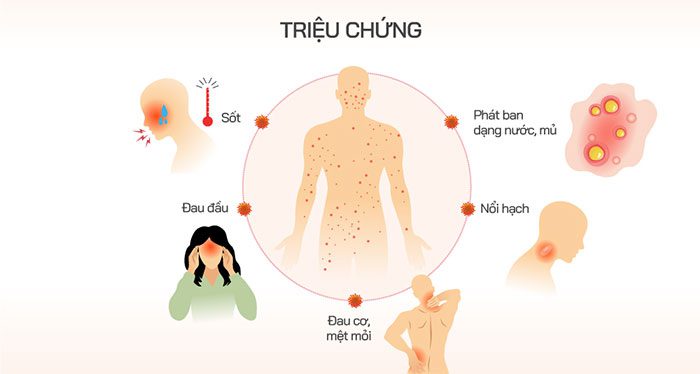 Symptoms of monkeypox.