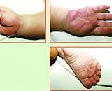 child with kawasaki disease artery disease 2612