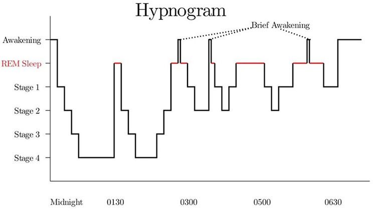 Hypnosis charts show that REM sleep duration increases with each sleep cycle.