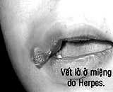 herpes