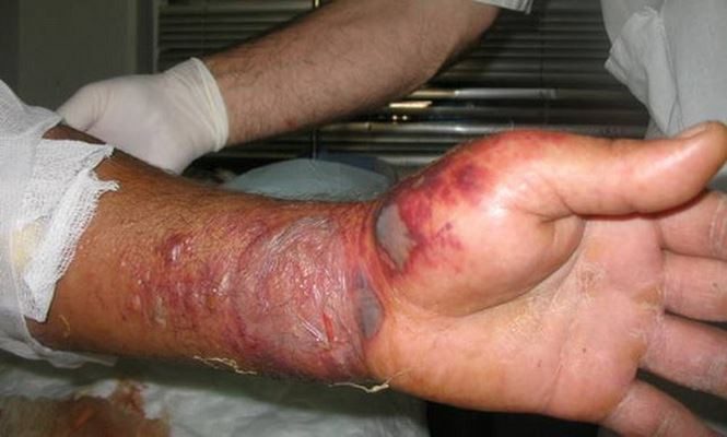 Symptoms of anthrax on human skin.