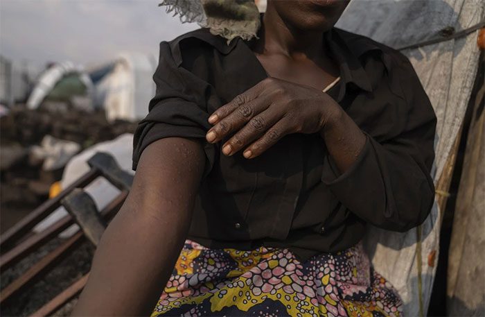 A woman in Congo suffering from monkeypox with itchy lesions on her hands.