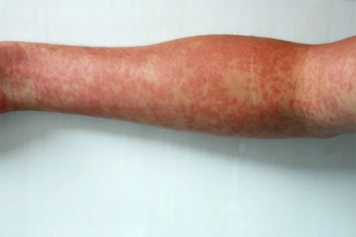 Rash is a typical sign when infected with dengue fever.